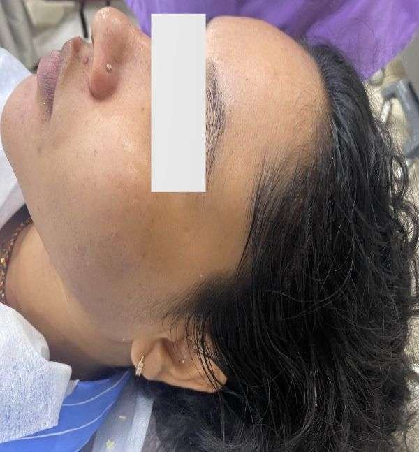 Before-Carbon Facial 
