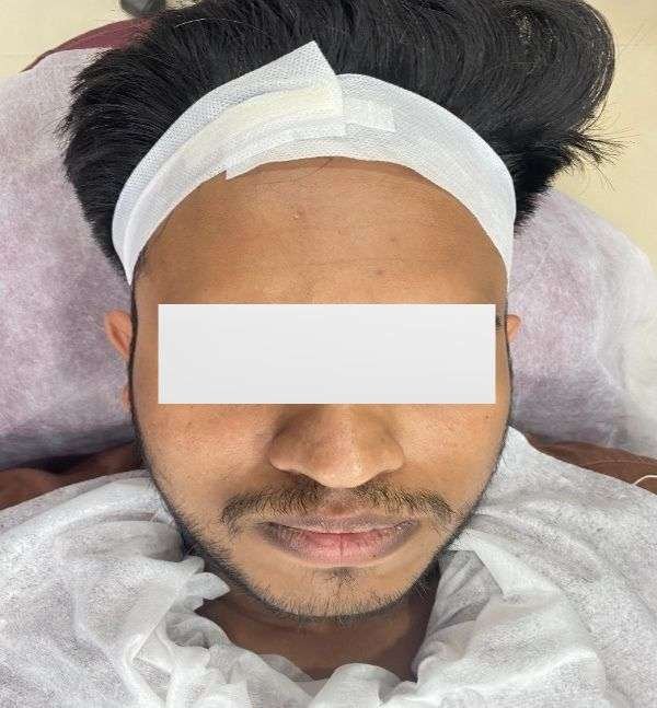 After-Acne scar reduction