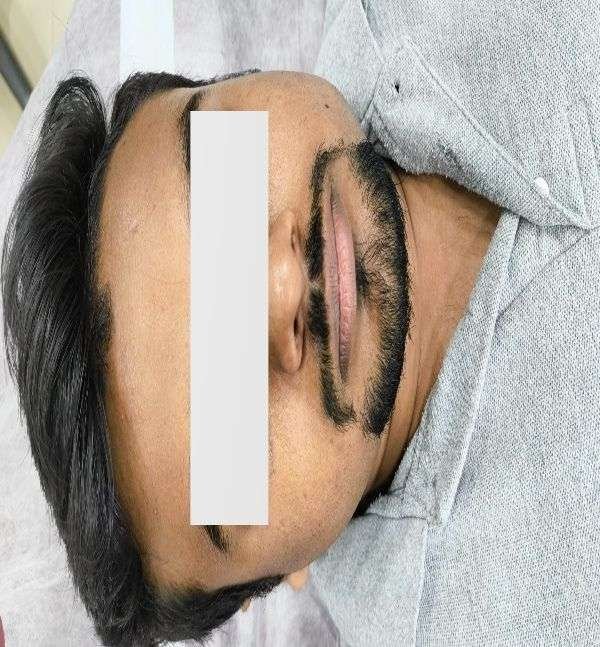 After-Hydrafacial