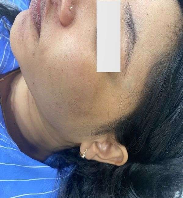 After-Carbon Facial 