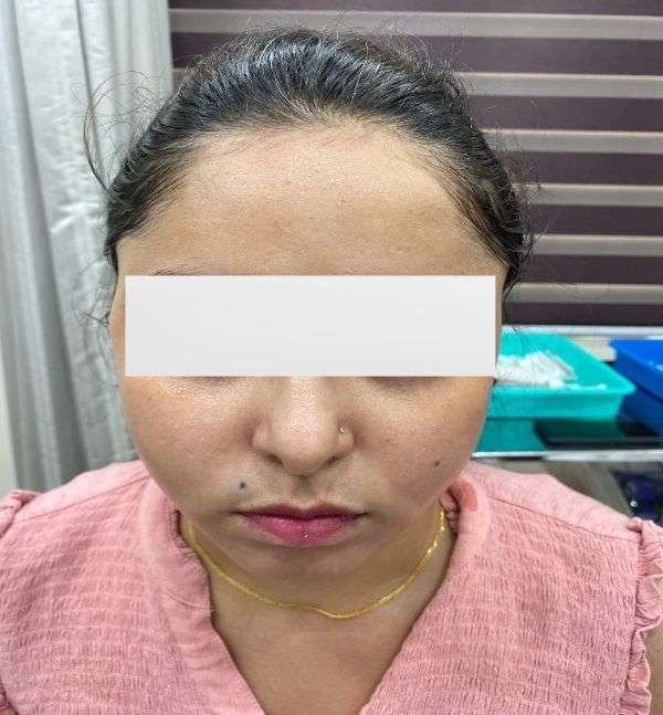 After-Hydrafacial 