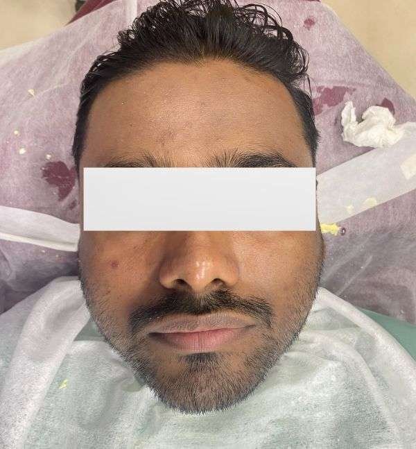 After-Hydrafacial