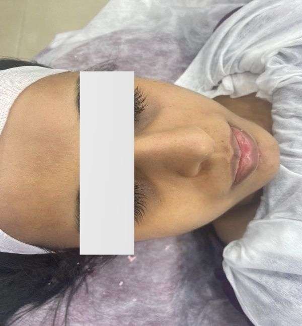 After-Under Eye Peel