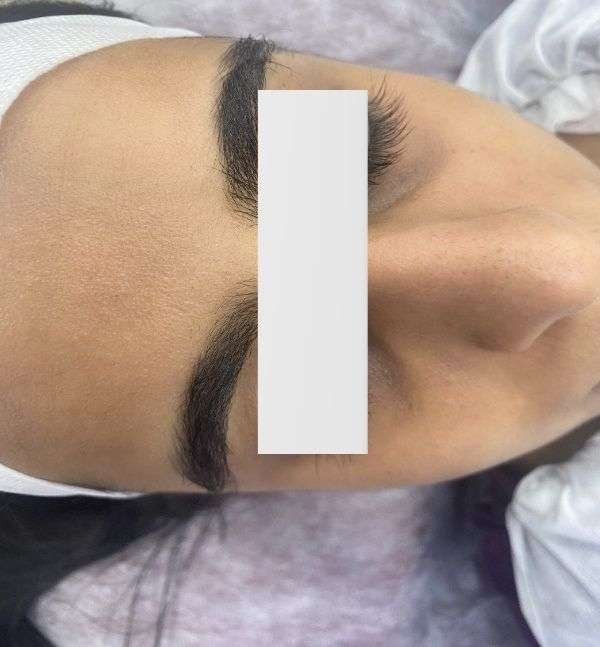 Before-Under Eye Peel