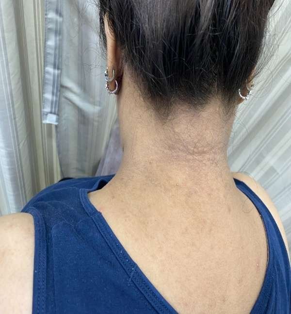 After-Neck Peel