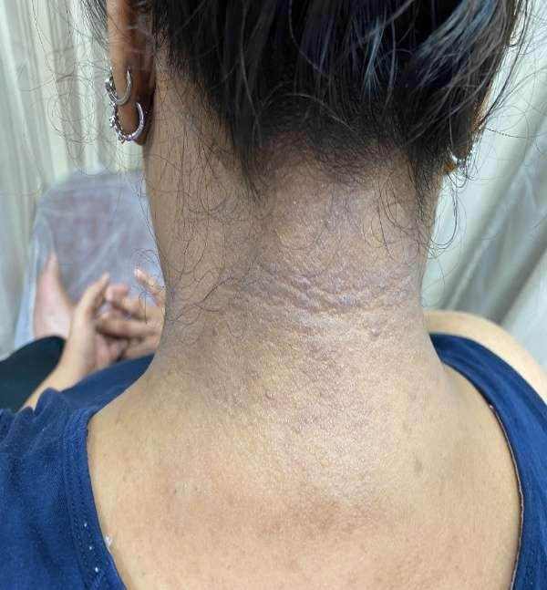 Before-Neck Peel